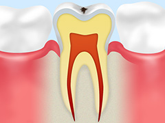 1.初期のむし歯（CO）