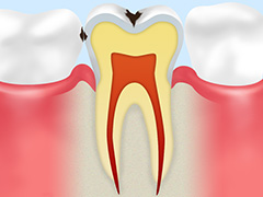 2.エナメル質のむし歯（C1）