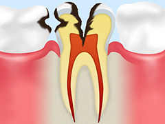4.歯の神経にまで達したむし歯（C3）