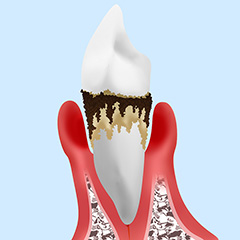 4.重度の歯周炎
